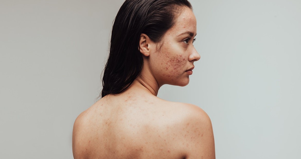 Mulher jovem que possui a pele com acne